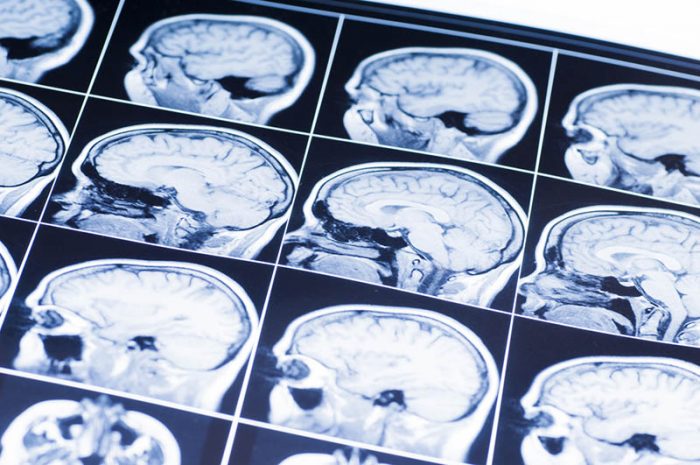 risks of traumatic brain injuries
