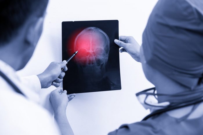 traumatic brain injuries in Glendale