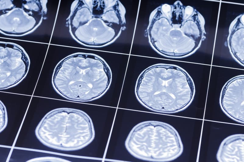 Traumatic Brain Injury Attorney Los Angeles