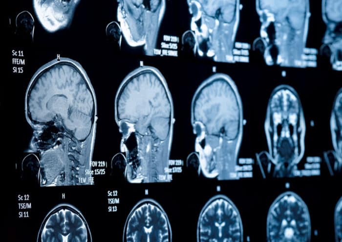 best Traumatic Brain Injury Attorney in Los Angeles