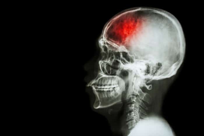 reputable traumatic brain injury attorney in LA