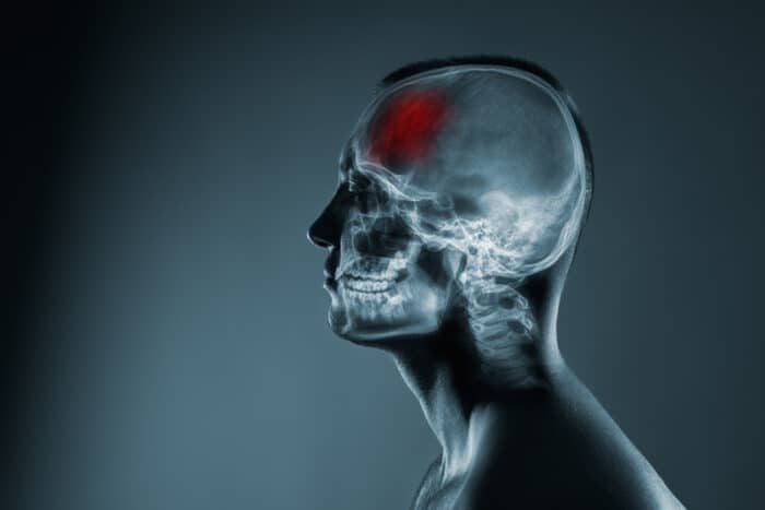 Traumatic Brain Injury Lawyer in Los Angeles CA