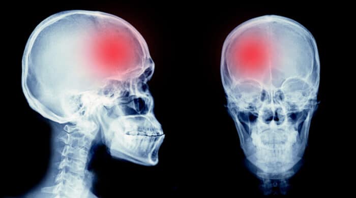 Brain Injury Lawyer in Los Angeles