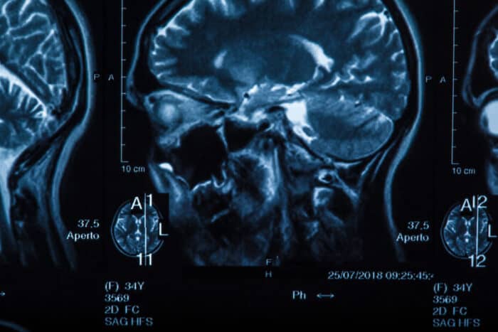 Los Angeles Brain Injury Attorney 