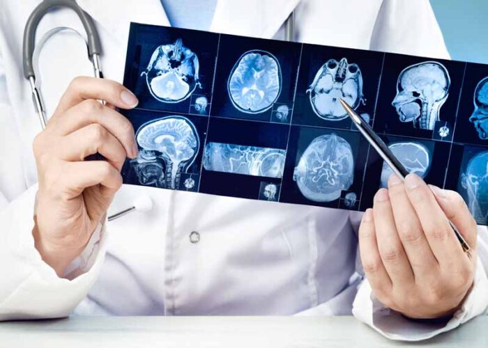 Los Angeles traumatic brain injury attorney